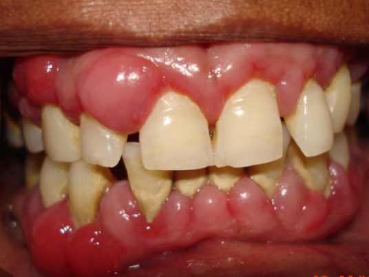 Dấu hiệu và triệu chứng bệnh viêm chân răng