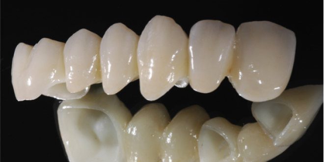 Độ bền của răng sứ Cercon như thế nào?