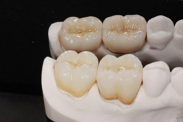 bọc răng sứ titan có ưu điểm gì