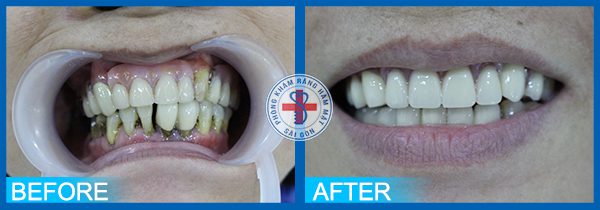 Trước và sau khi bọc răng sứ 3