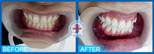 Tẩy trắng răng khắc phục hiện tượng răng vàng ố hiệu quả