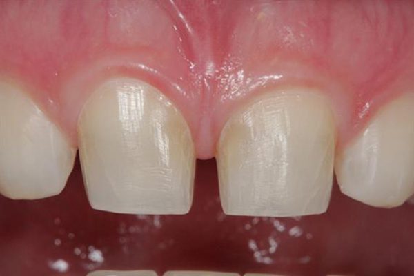 Trồng răng sứ có đau không?