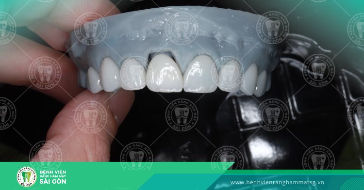 ưu điểm bọc răng toàn sứ cercon