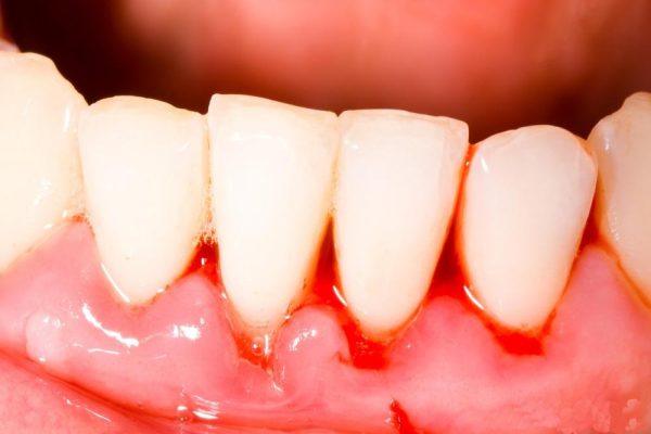 Nguyên nhân chảy máu chân răng là gì