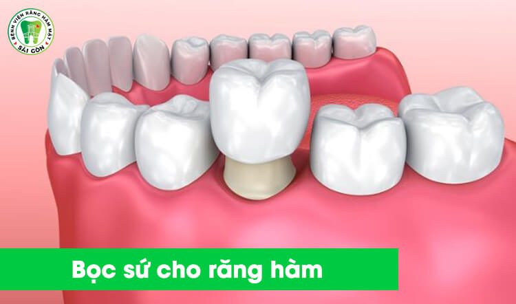 bọc răng sứ cho răng hàm