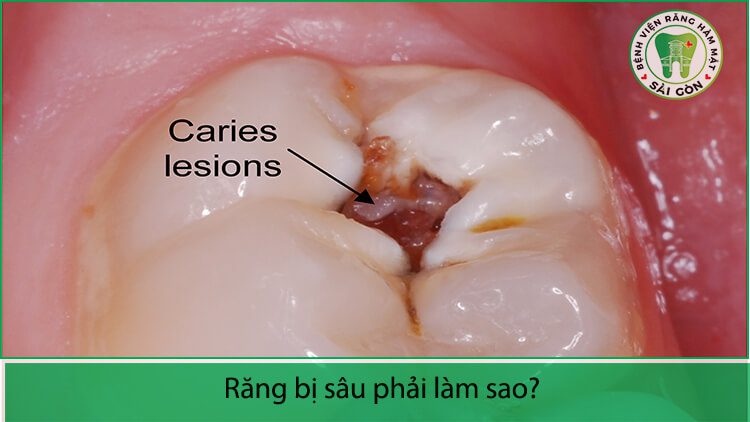 Răng bị sâu có nên bọc sứ không?