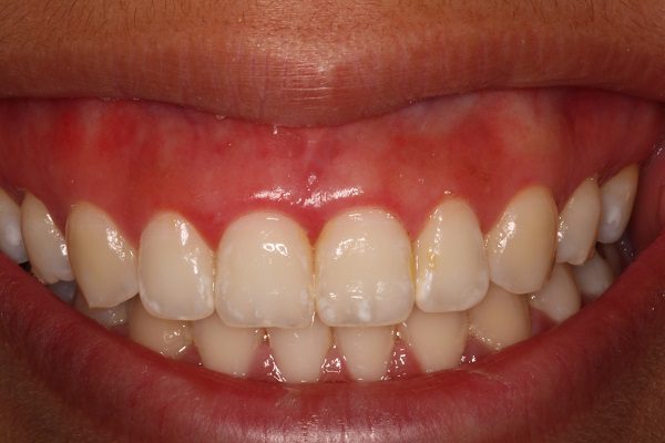 bệnh viêm chân răng có nguy hiểm không