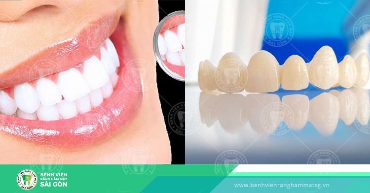 Cách xử lý tình trạng răng sứ không cùng màu với răng thật