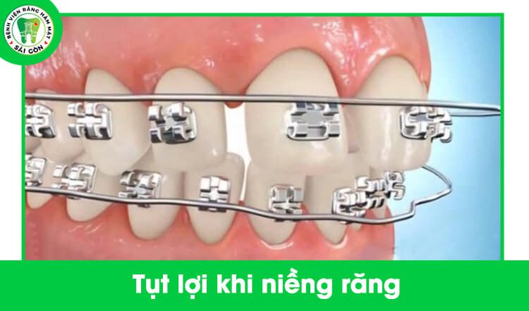 niềng răng bị tụt lợi