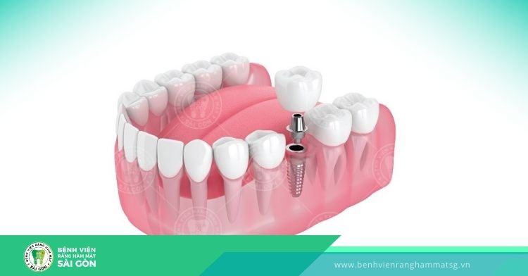 trồng răng vĩnh viễn với trụ implant