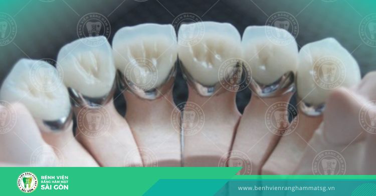 ưu điểm của răng sứ titan