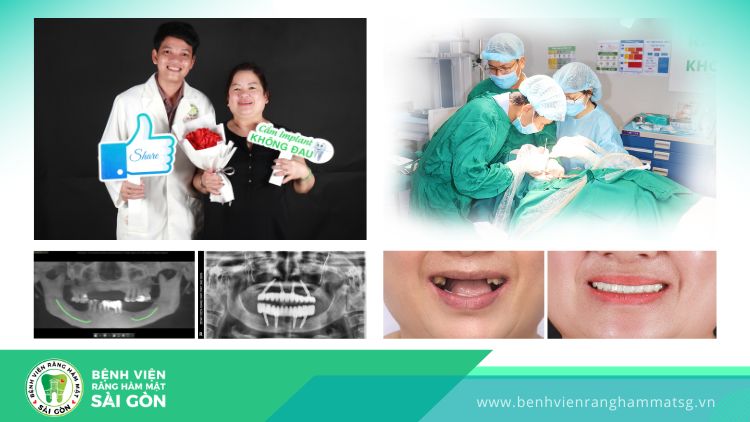 Phương pháp trồng răng implant all on 4