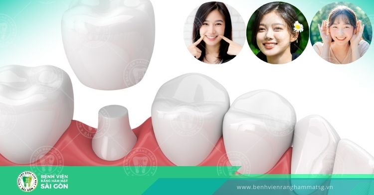 Răng toàn sứ - Ưu điểm và mẫu răng sứ nổi bật